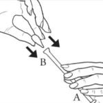 canesten capsule stap 1 inbrengen met applicator
