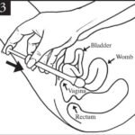 canesten capsule stap 3 inbrengen met applicator