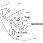 canesten creme inbrengen stap 3