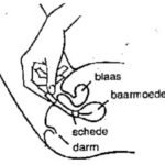 canesten tablet met hand inbrengen